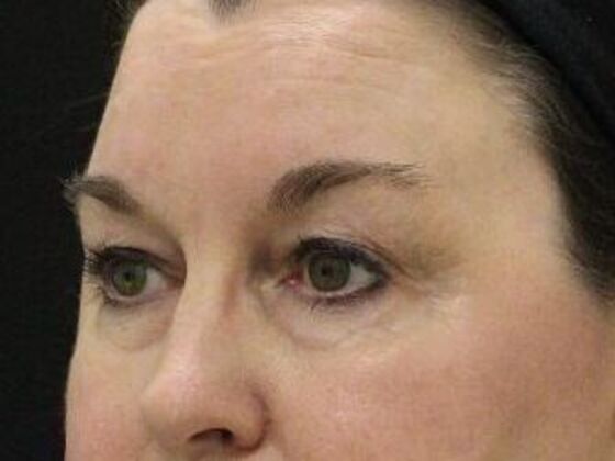 Eyelid Surgery: Case 13 - Before