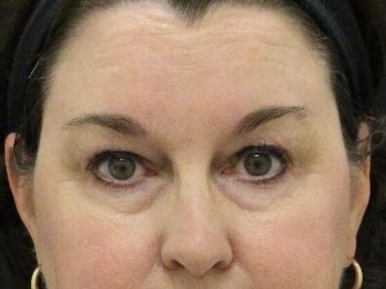 Eyelid Surgery Case 13 - Before