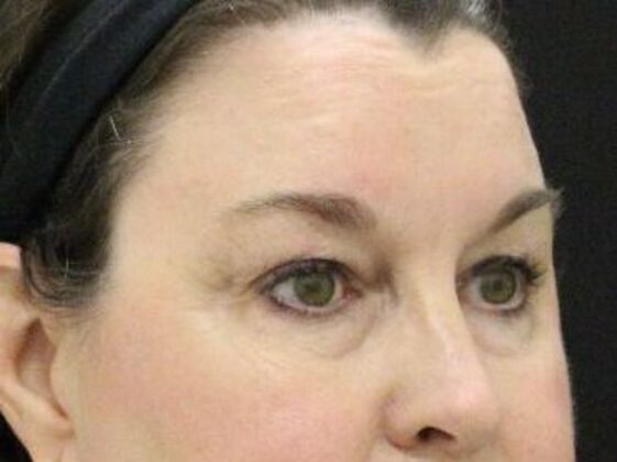 Eyelid Surgery: Case 13 - Before