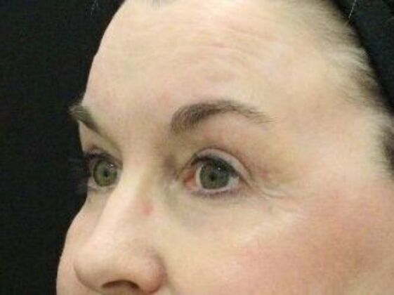 Eyelid Surgery: Case 13 - After