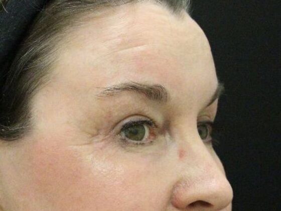 Eyelid Surgery: Case 13 - After