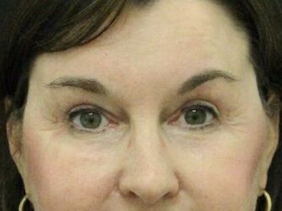 Eyelid Surgery Case 13 - After