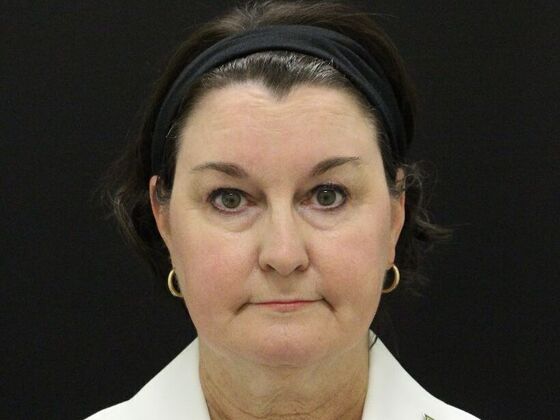 Non-Surgical: Case 6 - Before