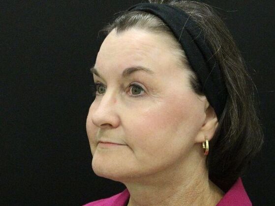 Non-Surgical: Case 6 - After