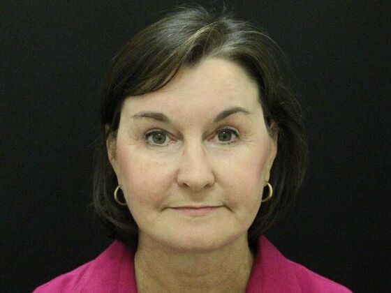 Non-Surgical: Case 6 - After