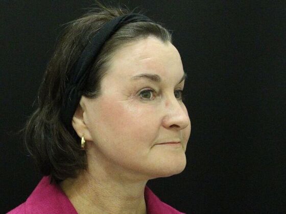 Non-Surgical: Case 6 - After