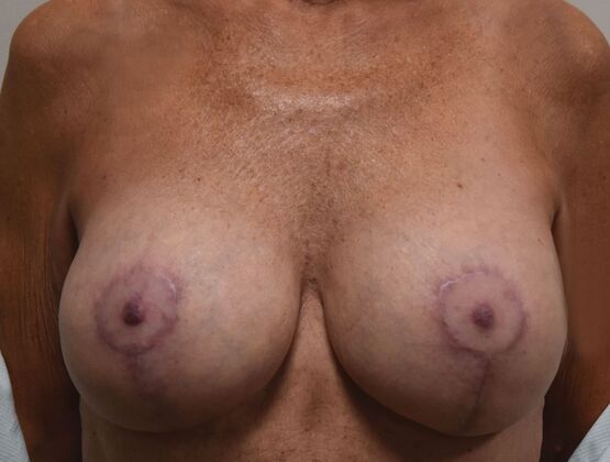 Breast Augmentation w/ Lift Case 524 - After