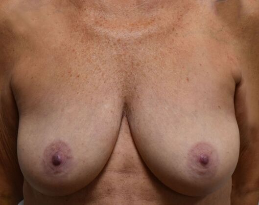 Breast Augmentation w/ Lift Case 524 - Before
