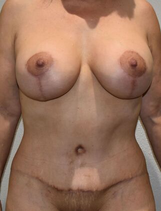 Mommy Makeover Case 298 - After