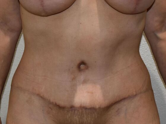 Tummy Tuck (Abdominoplasty): Case 468 - After