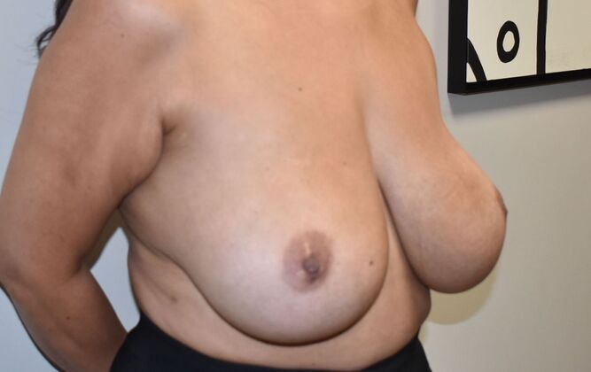 Breast Implant Removal: Case 38 - Before