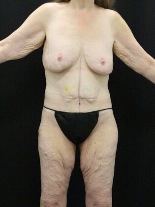 Tummy Tuck Case 36 - After