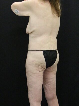 Tummy Tuck: Case 36 - After