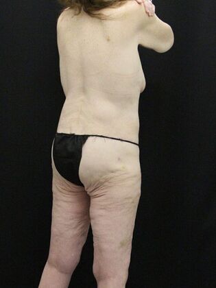 Tummy Tuck: Case 36 - After