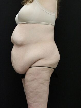 Tummy Tuck: Case 36 - Before