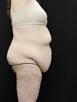 Tummy Tuck: Case 36 - Before