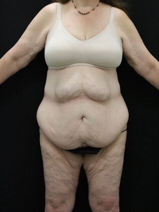 Tummy Tuck Case 36 - Before