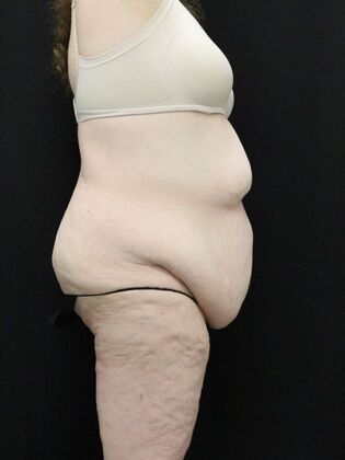 Body Lift: Case 3 - Before