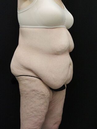 Body Lift: Case 3 - Before