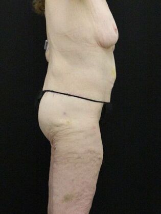 Body Lift: Case 3 - After