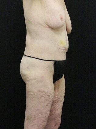 Body Lift: Case 3 - After