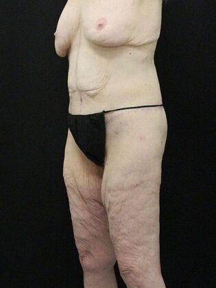 Body Lift: Case 3 - After