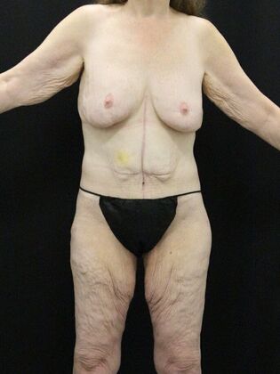 Body Lift: Case 3 - After