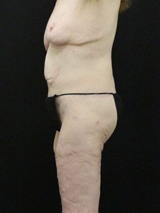 Body Lift: Case 3 - After