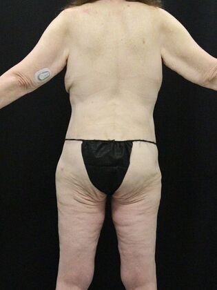 Body Lift Case 3 - After