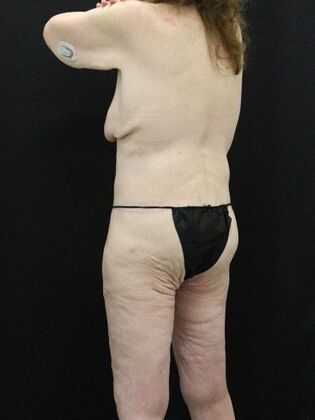 Body Lift: Case 3 - After