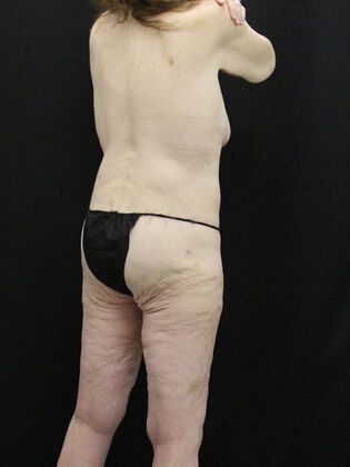 Body Lift: Case 3 - After
