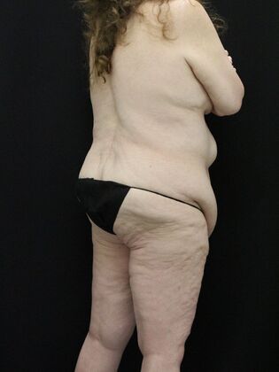 Body Lift: Case 3 - Before