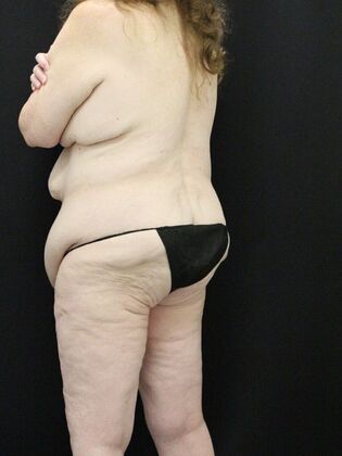 Body Lift: Case 3 - Before