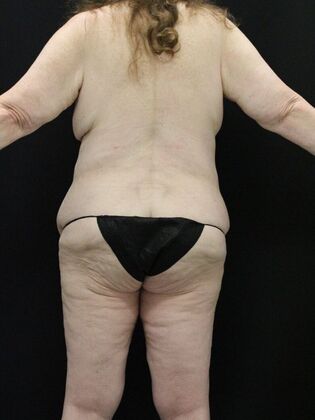 Body Lift Case 3 - Before