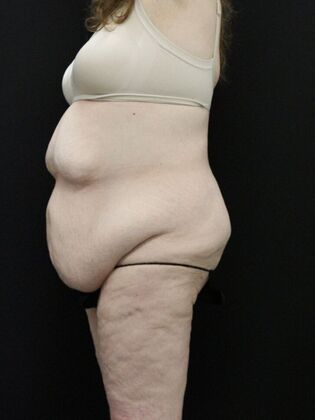 Body Lift: Case 3 - Before
