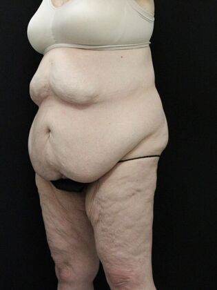 Body Lift: Case 3 - Before