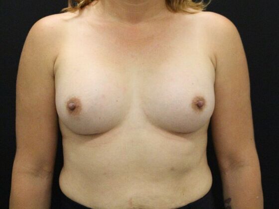 Breast Augmentation Case 28 - After
