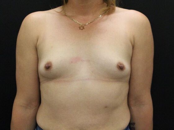 Breast Augmentation Case 28 - Before
