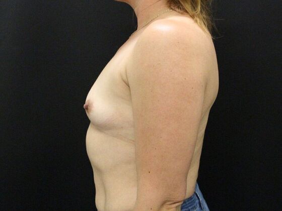 Breast Augmentation: Case 28 - Before