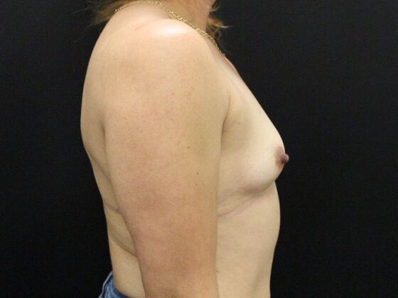 Breast Augmentation: Case 28 - Before