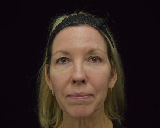 Facial Laser Rejuvenation  Case 2 - After