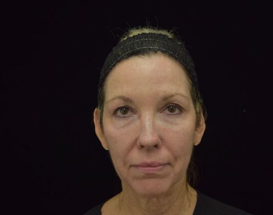 Facial Laser Rejuvenation  Case 2 - Before