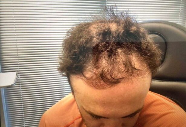 Hair Loss Case 1 - Before