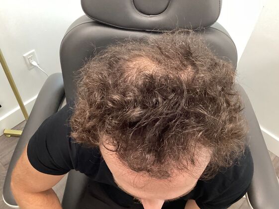 Hair Loss Case 1 - After