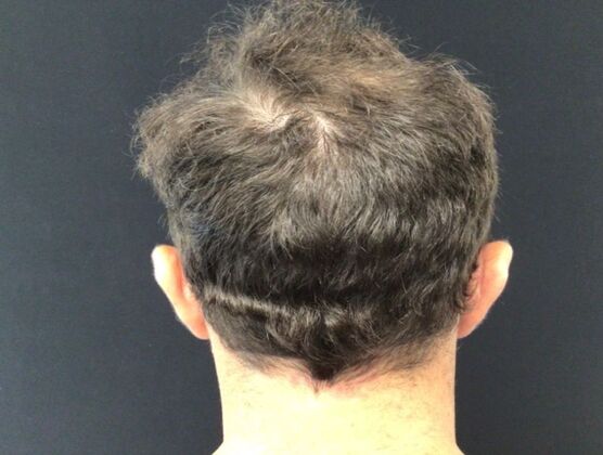 Hair Loss: Case 1 - Before