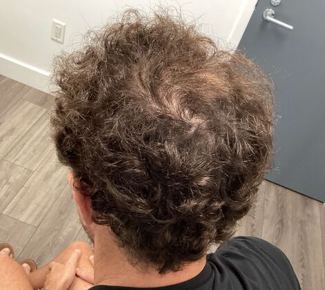 Hair Loss: Case 1 - After