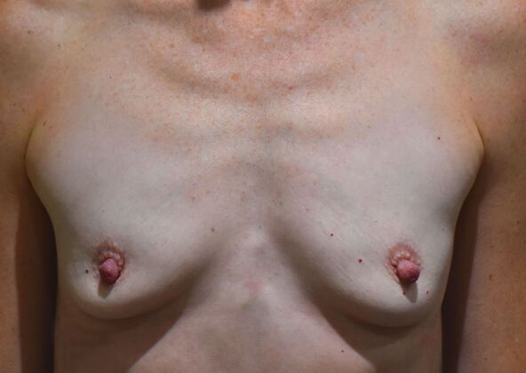 Breast Augmentation Case 757 - Before