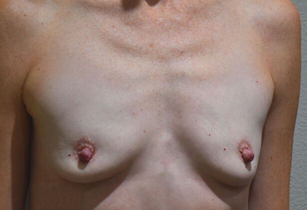 Breast Augmentation: Case 757 - Before