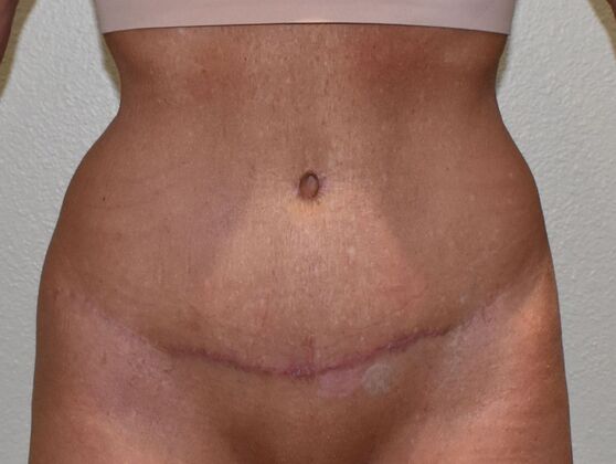 Tummy Tuck (Abdominoplasty): Case 469 - After