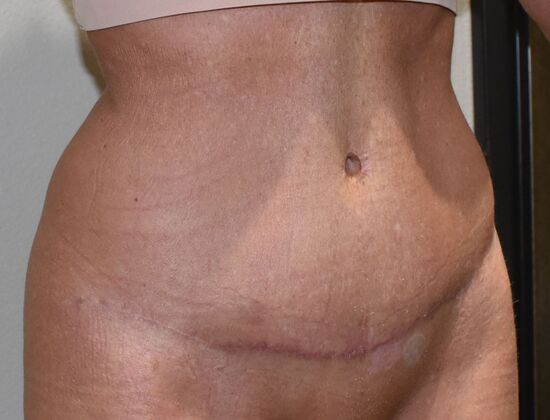 Tummy Tuck (Abdominoplasty): Case 469 - After